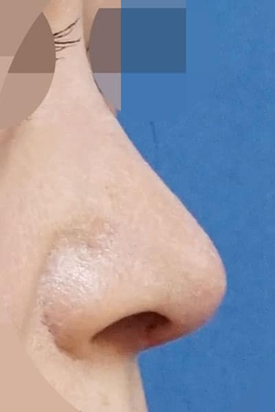 鼻尖形成・鼻中隔延長　１週間後　右斜め