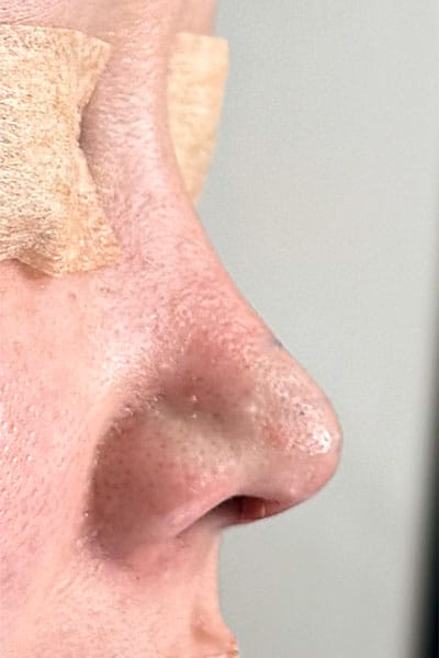 鼻尖形成・鼻中隔延長　手術直後　右側面のAfterの写真