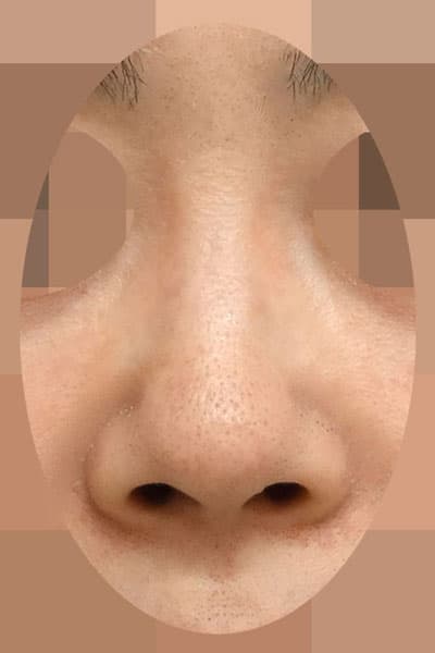 鼻尖形成・鼻中隔延長　手術前　正面