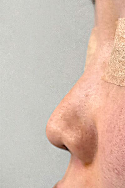 鼻尖形成・鼻中隔延長　手術直後　左側面のBefore写真