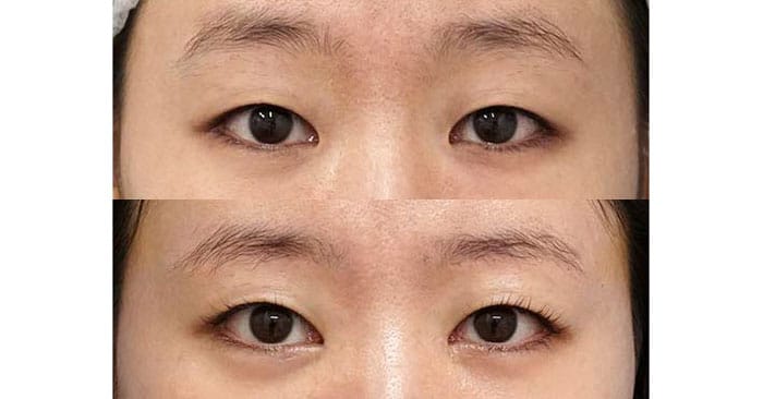 目を縦横に大きく｜眉下切開＋目頭切開Z形成　６ヶ月後