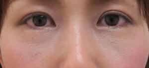 裏ハムラ１週間後