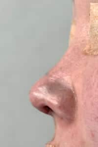 鼻中隔延長　手術直後　左側面