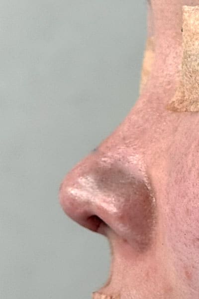 鼻尖形成・鼻中隔延長　手術直後　左側面のAfterの写真