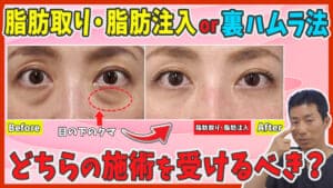 目の下のクマ取り整形は脂肪取り・脂肪注入と裏ハムラ法のどちらを選ぶべき？