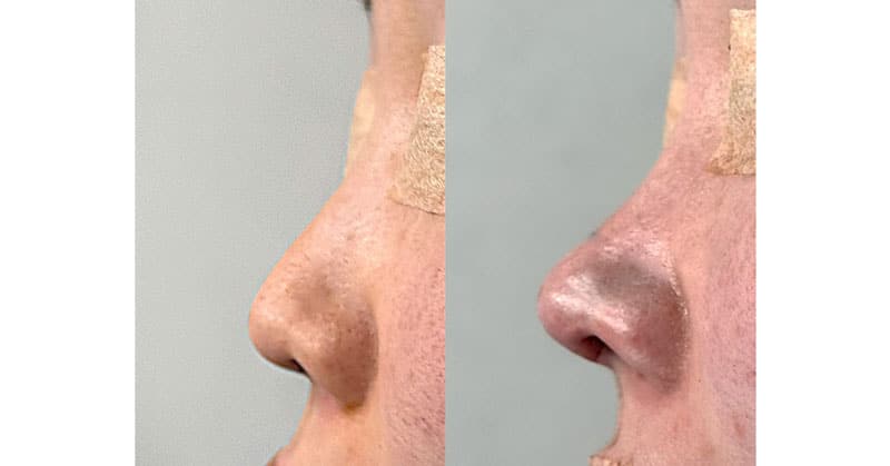 鼻中隔延長　手術直後　左側面　サムネイル