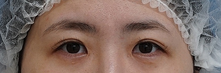 目頭切開（リドレープ法） 術後6か月のBefore写真