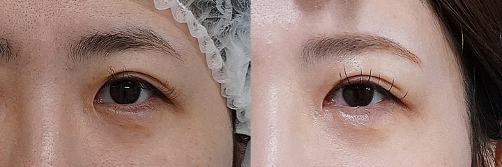 目頭切開（リドレープ法）｜自然な変化で、目元の印象を整える