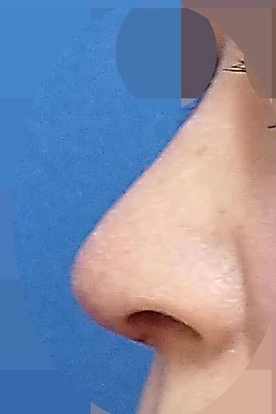鼻尖形成・鼻中隔延長　１週間後　左斜め