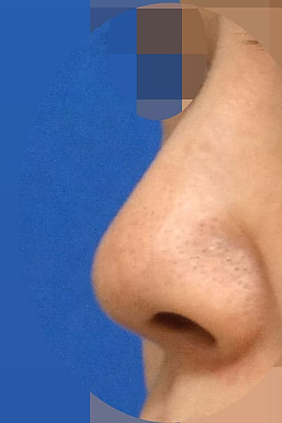 鼻尖形成・鼻中隔延長　手術前　左斜め