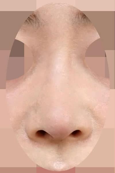 鼻尖形成・鼻中隔延長　１週間後　正面