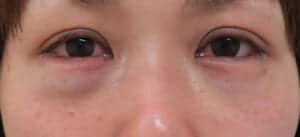 裏ハムラ手術直後