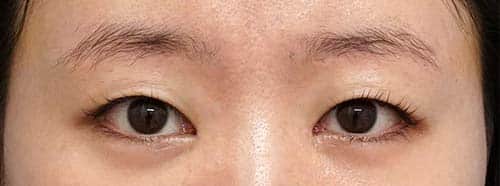 眉下切開＋目頭切開Z形成　６ヶ月後のAfterの写真