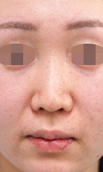 鼻尖形成・鼻中隔延長　正面　術前