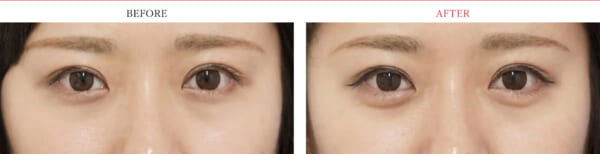 涙袋ヒアルロン酸症例1