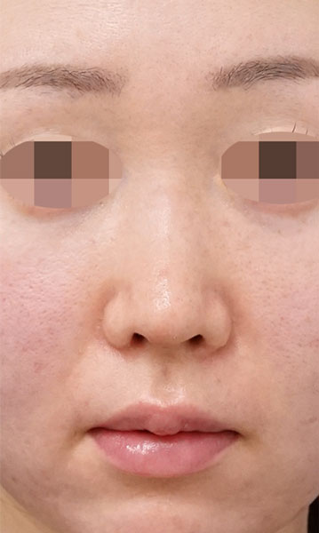 鼻尖形成・鼻中隔延長　正面　３ヶ月後