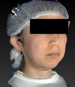 バッカルファット除去　右斜め　手術前