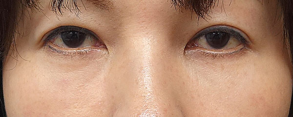 目の下くま取り（裏ハムラ）　３ヶ月後経過のAfterの写真