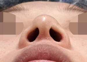 術前鼻下から