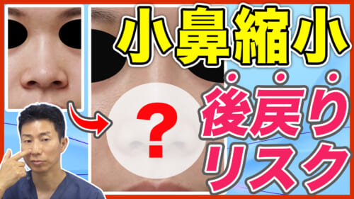 【鼻整形】小鼻縮小術を受けた後の後戻りはどのくらい？リスクを防ぐ方法について徹底解説