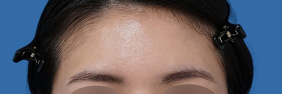 額ヒアルロン酸 術後1週間 正面のAfterの写真