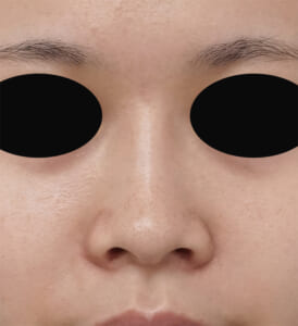 小鼻縮小(フラップ法)術後 正面