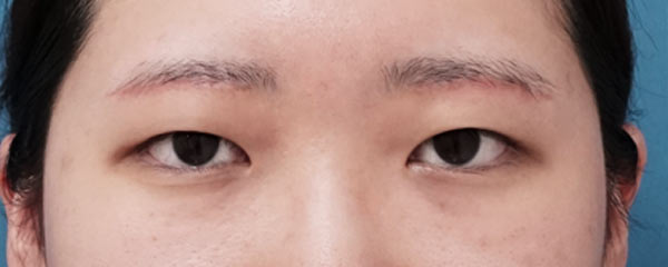 眉下切開　１ヶ月後のAfterの写真