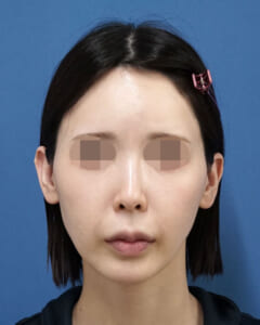 ホホ・貴族処置前