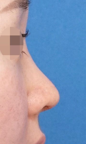 鼻尖形成・鼻中隔延長　右側面　３ヶ月後