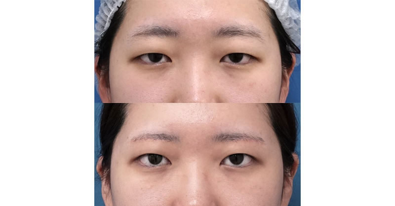 二重にしたくないけれど目を明るくしたい｜眉下切開　１週間～３ヶ月後