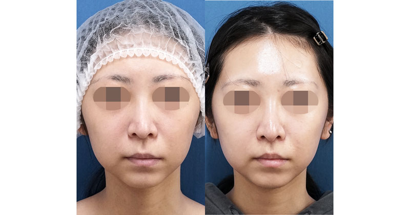 人中短縮（リップリフト）でお顔のバランスを整える｜人中短縮　１週間後、３ヶ月後