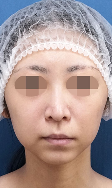 人中短縮術(リップリフト) 手術前