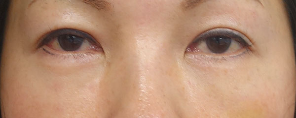 目の下のクマ取り（裏ハムラ法）　１週間後のAfterの写真