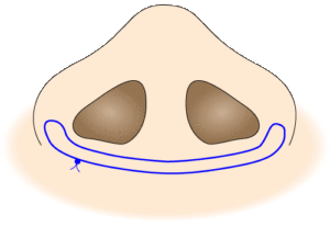 鼻翼縮小 糸縫い