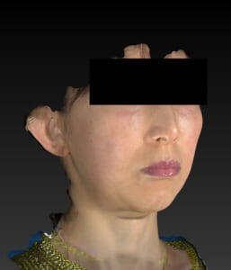 バッカルファット除去　右斜め　3ヶ月後