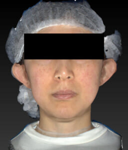 バッカルファット除去　正面　3ヶ月後