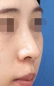 3か月後鼻右斜め
