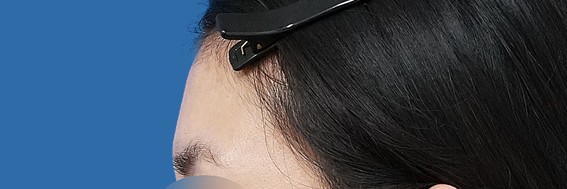 額ヒアルロン酸 術後1週間 側面のBefore写真