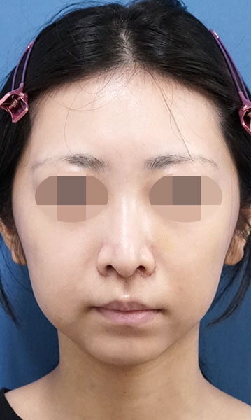 人中短縮術（リップリフト）　１週間後