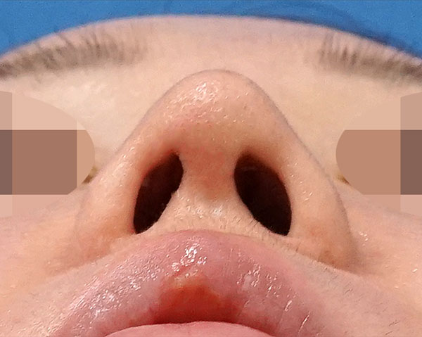 鼻尖形成・鼻中隔延長　下から　３ヶ月後