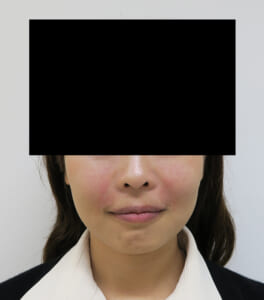 症例①処置直後