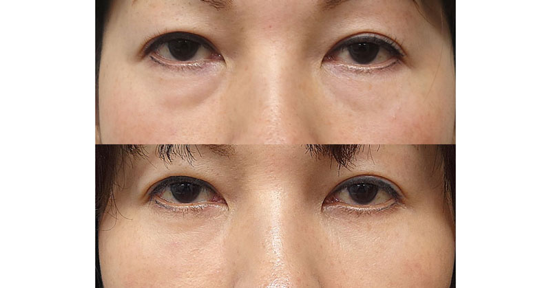 目の下くま取り（裏ハムラ）　１週間後～３ヶ月後経過