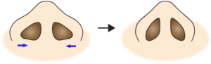鼻翼縮小(フラップ法)変化