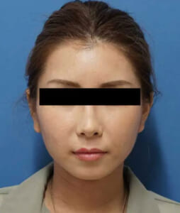 アゴヒアルロン酸