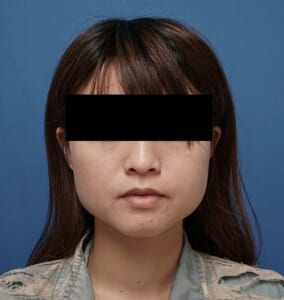 エラボトックス処置前