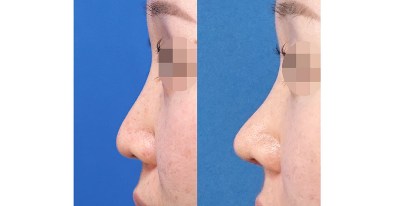 鼻中隔延長で鼻先をしっかり高く｜鼻尖形成・鼻中隔延長　１ヶ月後