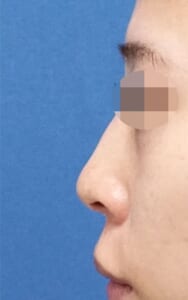 術前鼻左側面