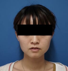 エラボトックス1ヶ月後