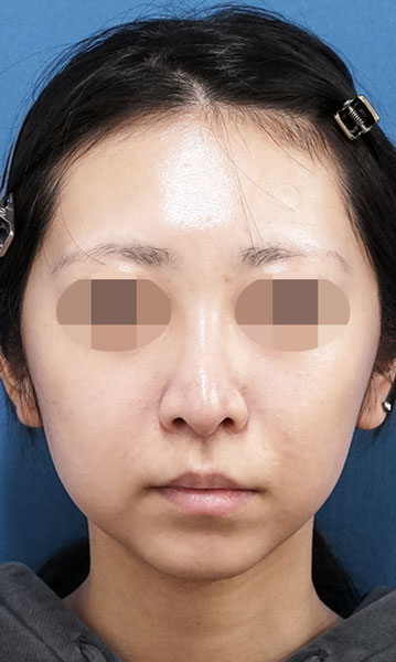 人中短縮術(リップリフト) 3ヶ月後