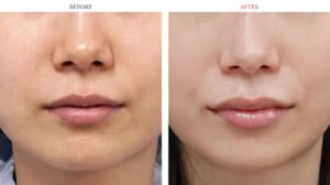 唇のヒアルロン酸